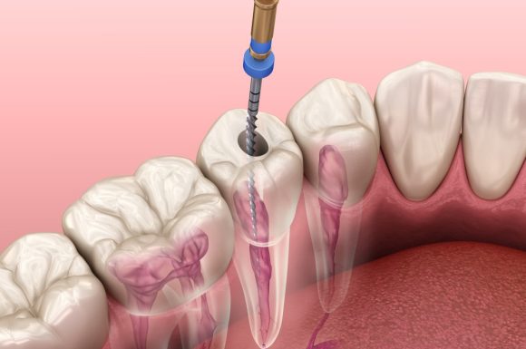 Cleaning & Shaping in Endodontics