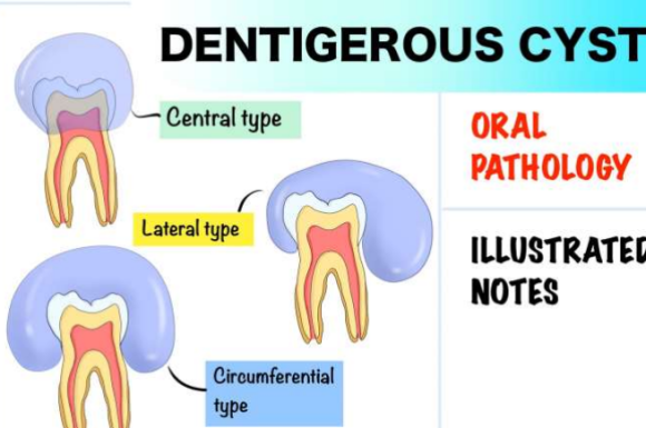 Cysts & Odotogenic Tumors